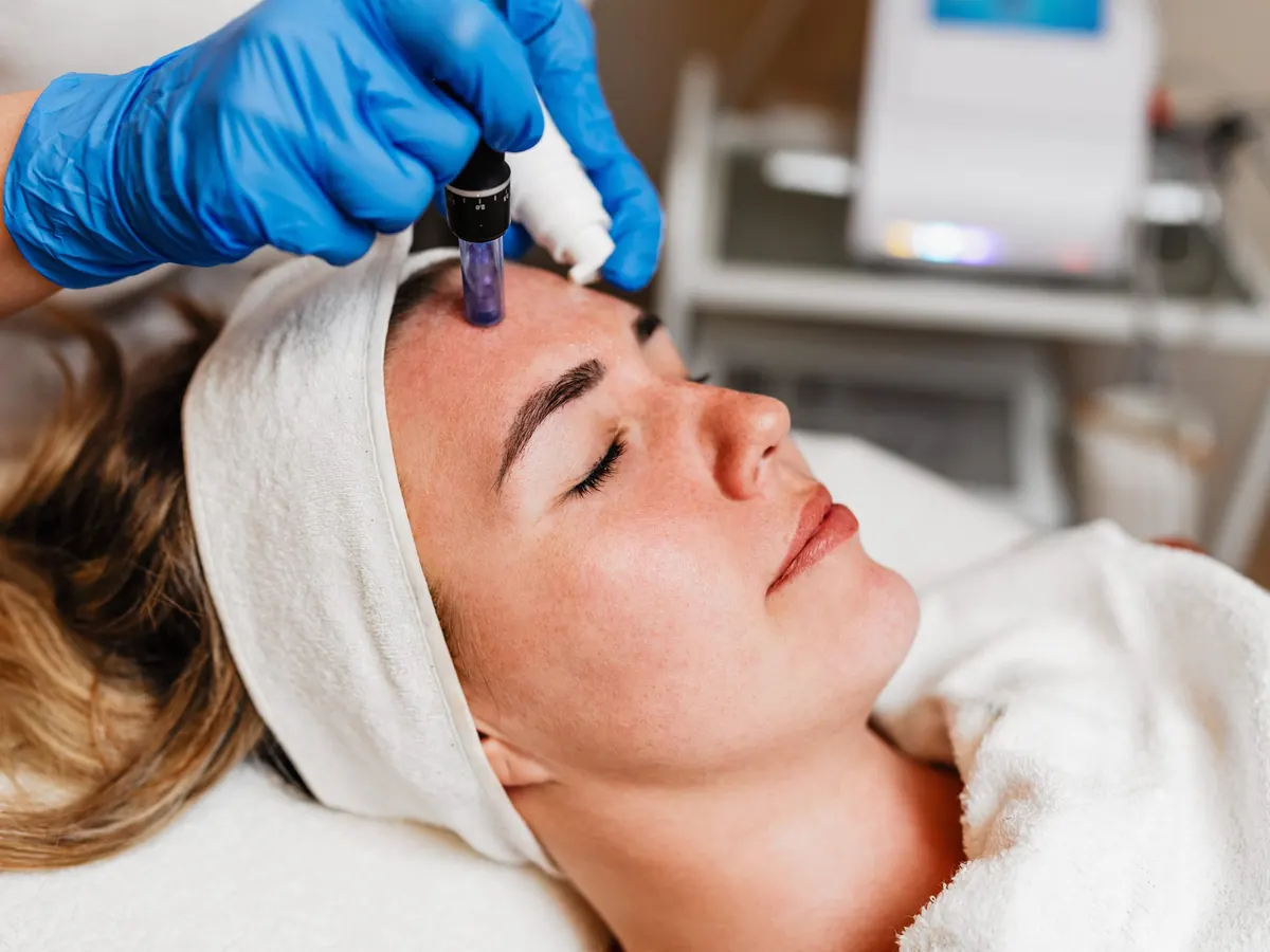 A microneedling pen treatment on a woman's forehead