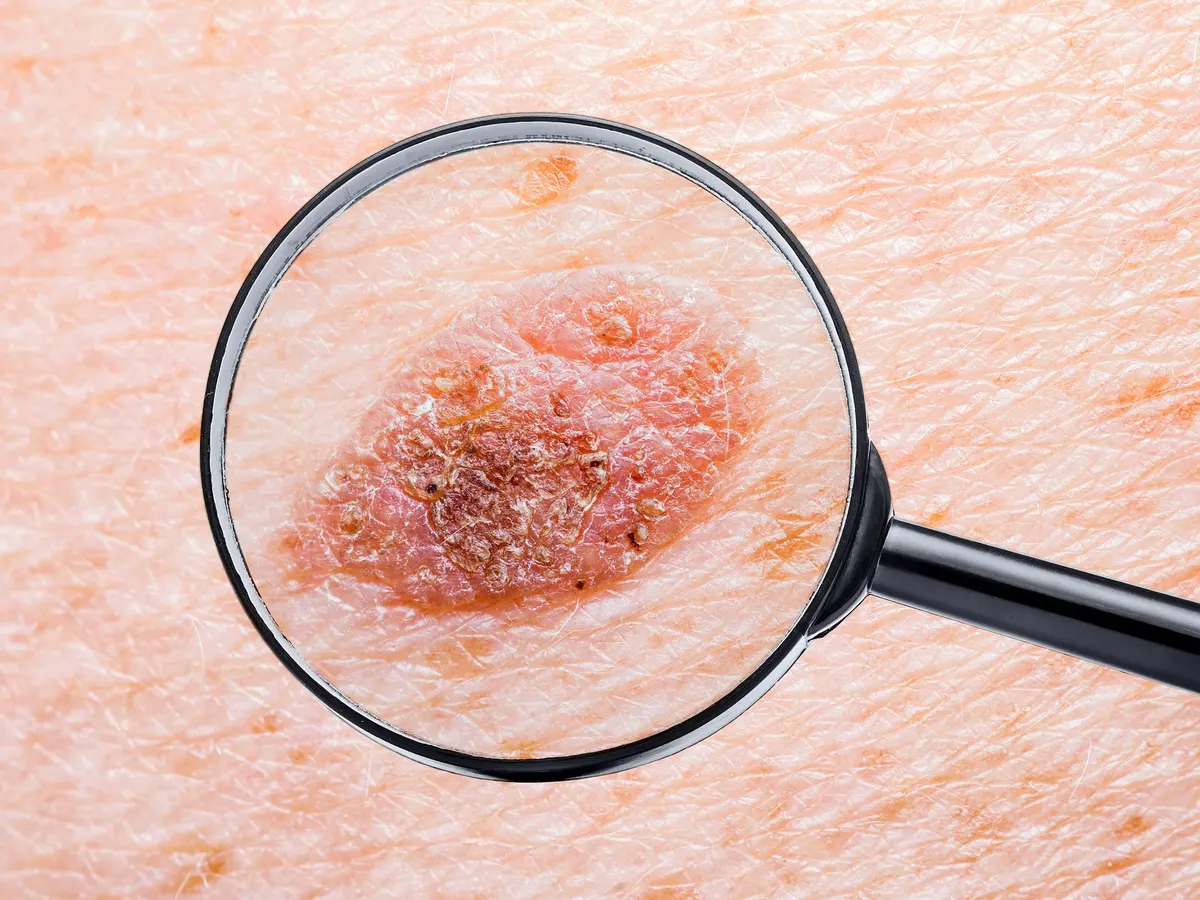 A spot on the skin seen through a magnifying glass