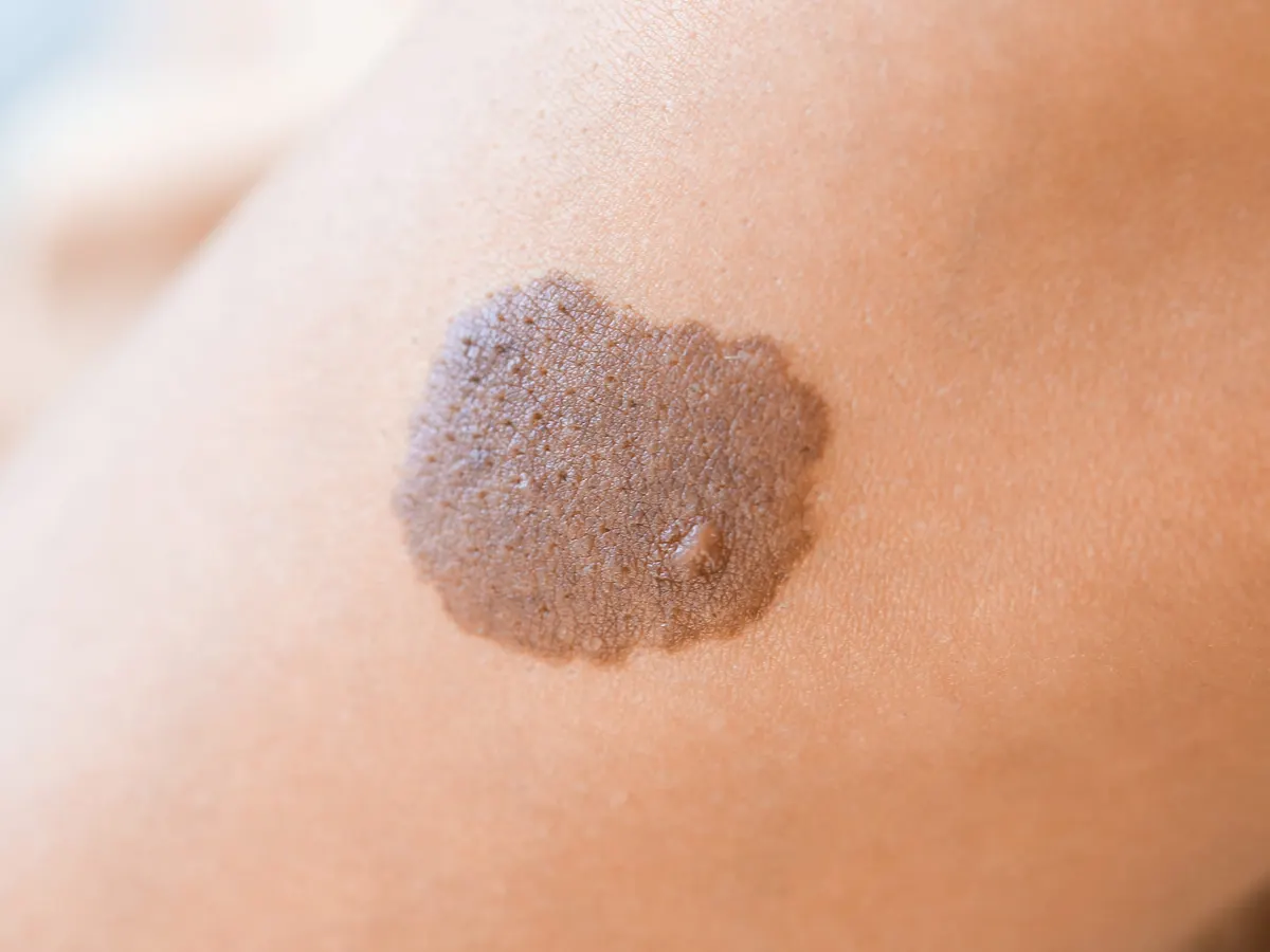 Close-up of a birthmark on the skin