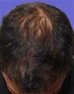after Image of Hair Restoration San Antonio TX