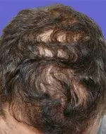 Before Image of Hair Restoration San Antonio TX