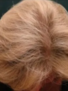 after Image of Hair Restoration Procedure San Antonio TX