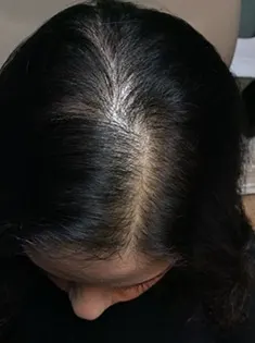 after Image of Hair Restoration Leon Valley TX
