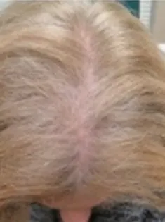 Before Image of Hair Restoration Procedure San Antonio TX