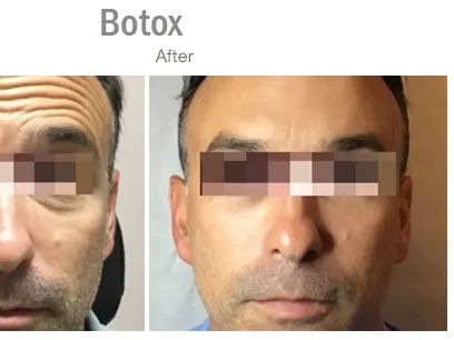 Before & after Image of Botox San Antonio TX