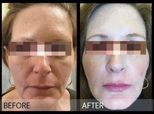 Before & after Image of Voluma treatment San Antonio TX