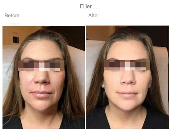 Before & after Image of Voluma Leon Valley