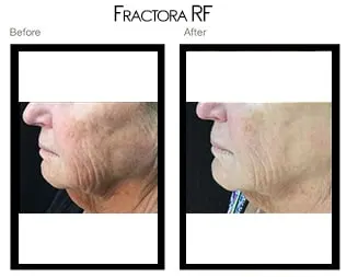 Before & after Image of Fractora RF San Antonio TX