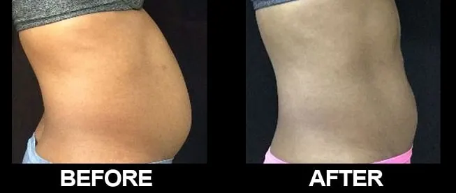 Before & after Image of Body Contouring San Antonio TX