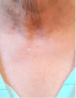 after Image of Photofacial IPL Treatment Leon Valley TX
