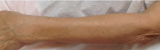 after Image of IPL Treatment Leon Valley TX