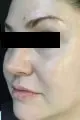 after Image of IPL Treatment San Antonio TX