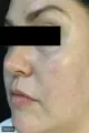 Before Image of IPL Treatment San Antonio TX
