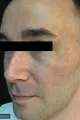 Before Image of Photofacial IPL Treatment San Antonio TX