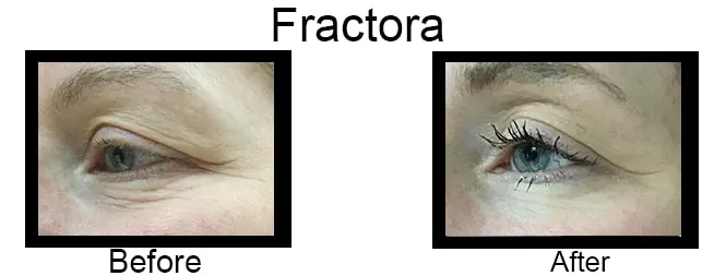 Before & after Image of Fractora RF Leon Valley TX