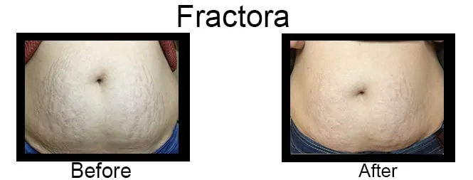 Before & after Image of Fractora Leon Valley TX