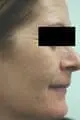 after Image of Intense Pulse Light Photorejuvenation San Antonio TX