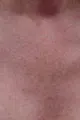 after Image of Photofacial Treatment Leon Valley TX