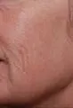 after Image of Photofacial Treatment San Antonio TX