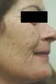 Before Image of Intense Pulse Light Photorejuvenation San Antonio TX