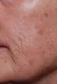Before Image of Photofacial Treatment San Antonio TX