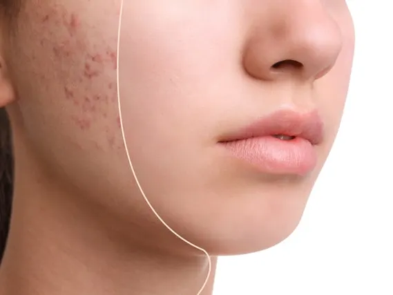 Teenage girl before and after acne treatment