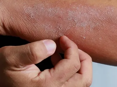 Eczema Treatment San Antonio TX