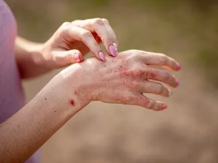 ill allergic rash eczema skin of patients hand