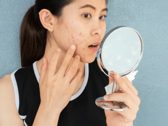 woman worry about her face when she saw the problem of acne inflammation