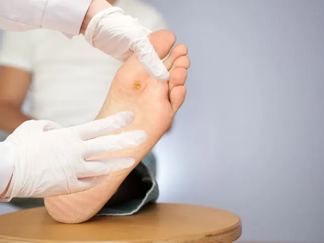 medical consultation at the removal of wart