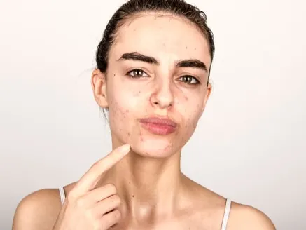 young girl with acne problematic skin