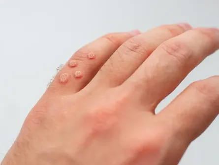 Viral warts on hand.