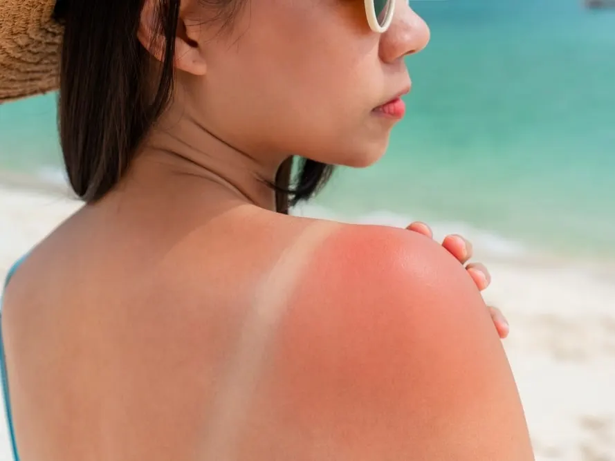 Sunburned,Skin,On,Shoulder,Of,A,Woman,Because,Of,Not