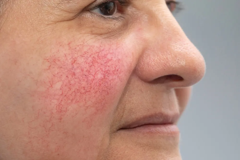 Rosacea Treatment Leon Valley TX