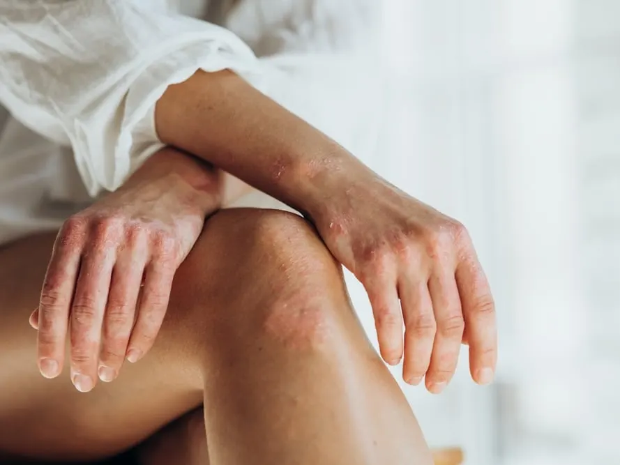 Close up of woman’s hands and knees experiencing a psoriasis flareup in the fall.