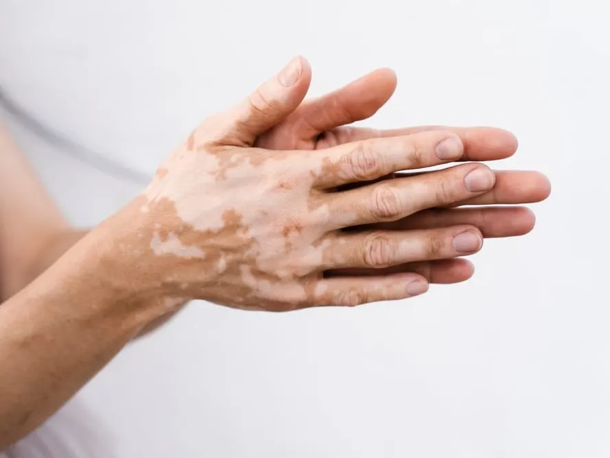 Vitiligo on a woman’s hands