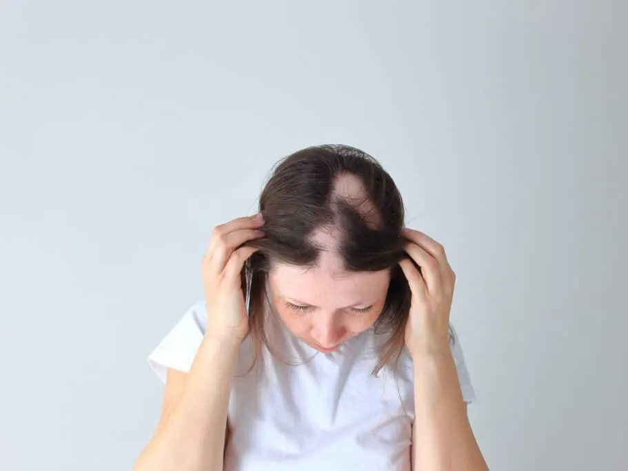 A woman with bald patches before PRP hair restoration in San Antonio