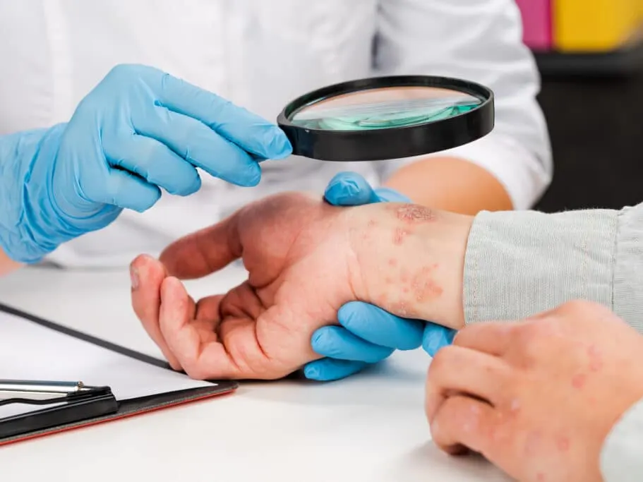 A dermatologist examining a patient with dyshidrotic eczema on their hands