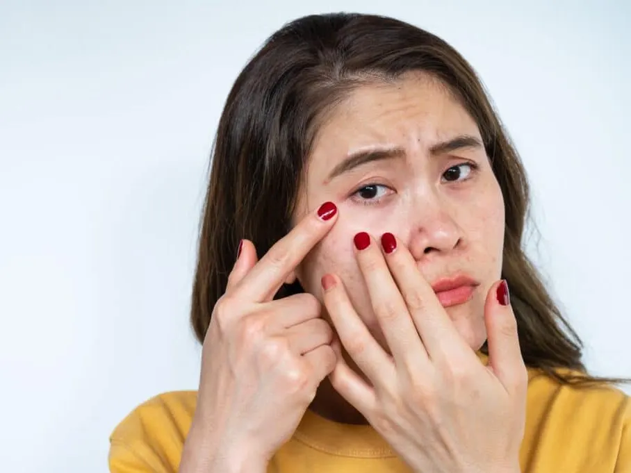 A woman looking at acne before starting Accutane®