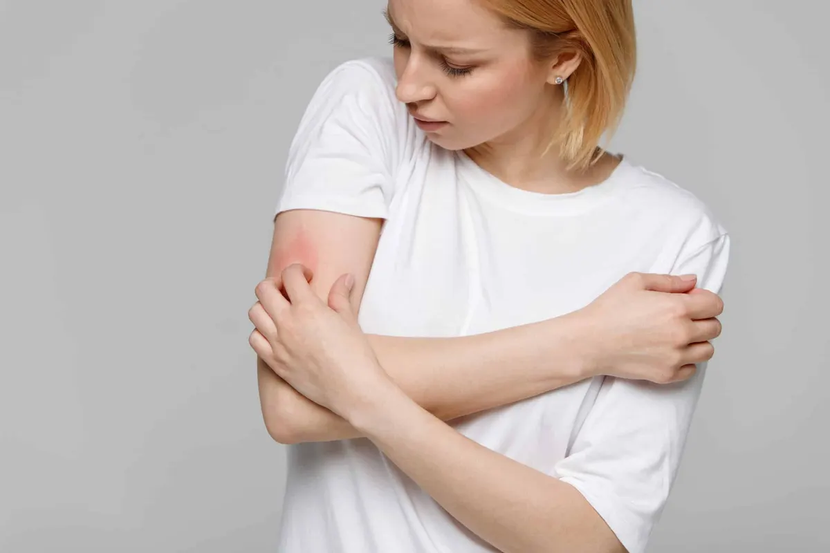 A woman with a rash scratching her arm