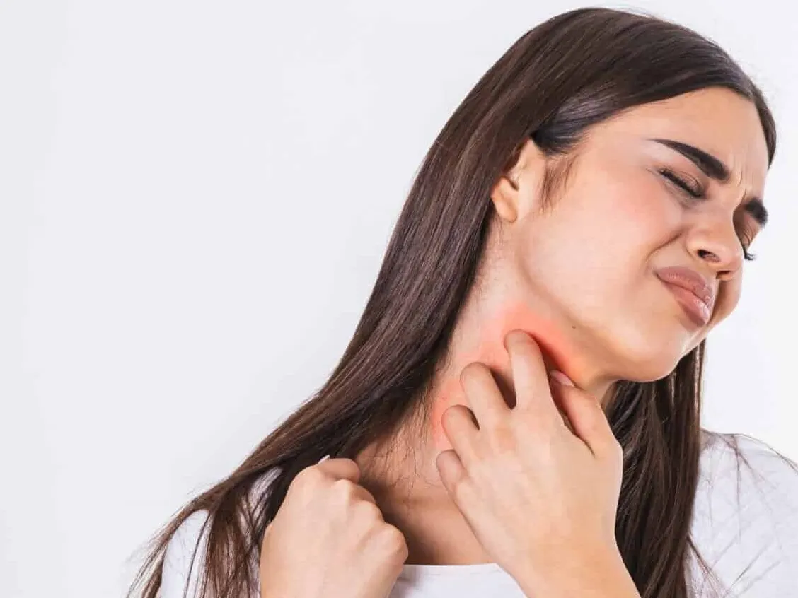 A woman with a rash scratching her neck