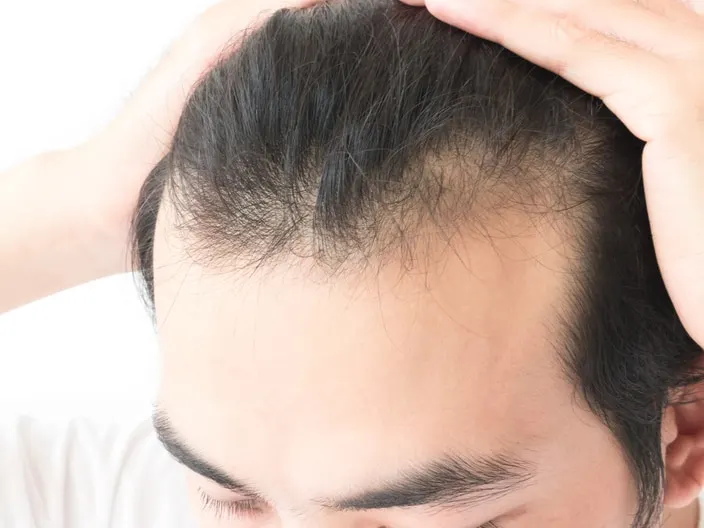 A close-up shot of a man’s hair before PRP hair restoration in San Antonio