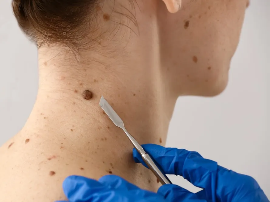 A dermatologist removing a mole with a lancet
