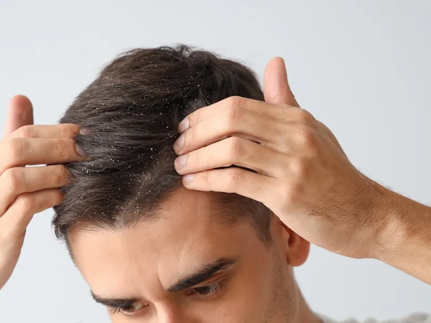 Man with psoriasis or dandruff scratching his scalp