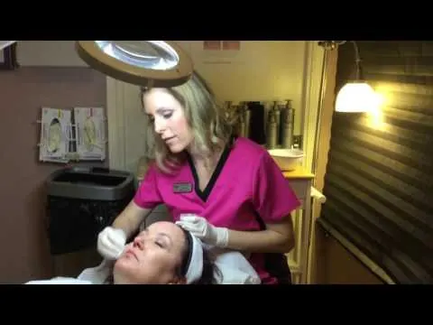 Chemical Peels