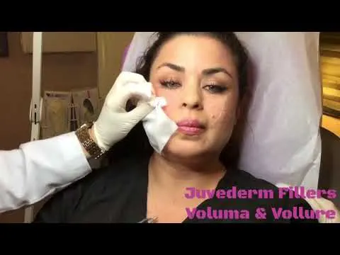 Voluma and Vollure filler treatment