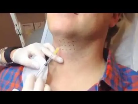 Kybella Injection