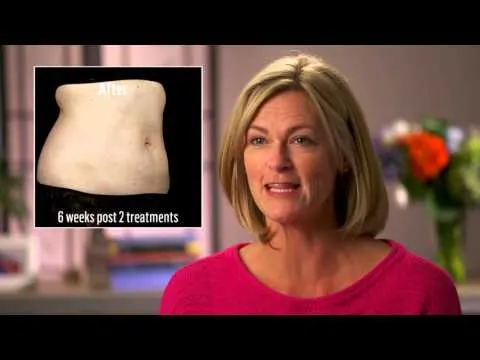 SculpSure WaitingRoomVideo PatientTestimonials