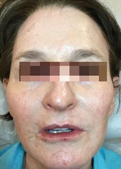 After Image: Botox, Fillers, Fractora, Chemical Peels, and SkinMedica - front