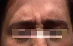 Before Image: Botox - front